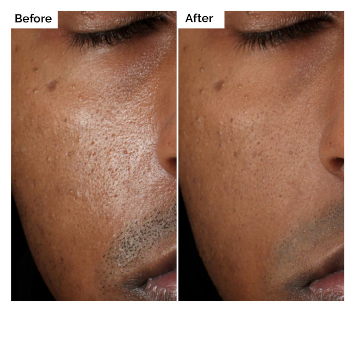Aloe 2% + NAG 2% Solución Suer - Aha Bha Exfoliant reseña y precio